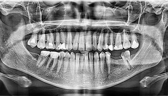 dental_xray